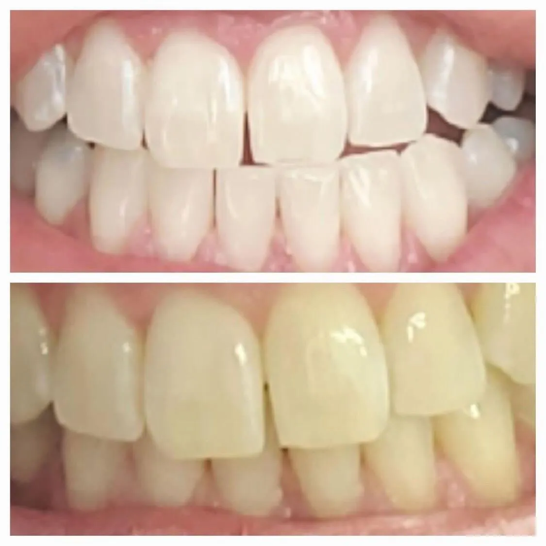 organic teeth whitening gel