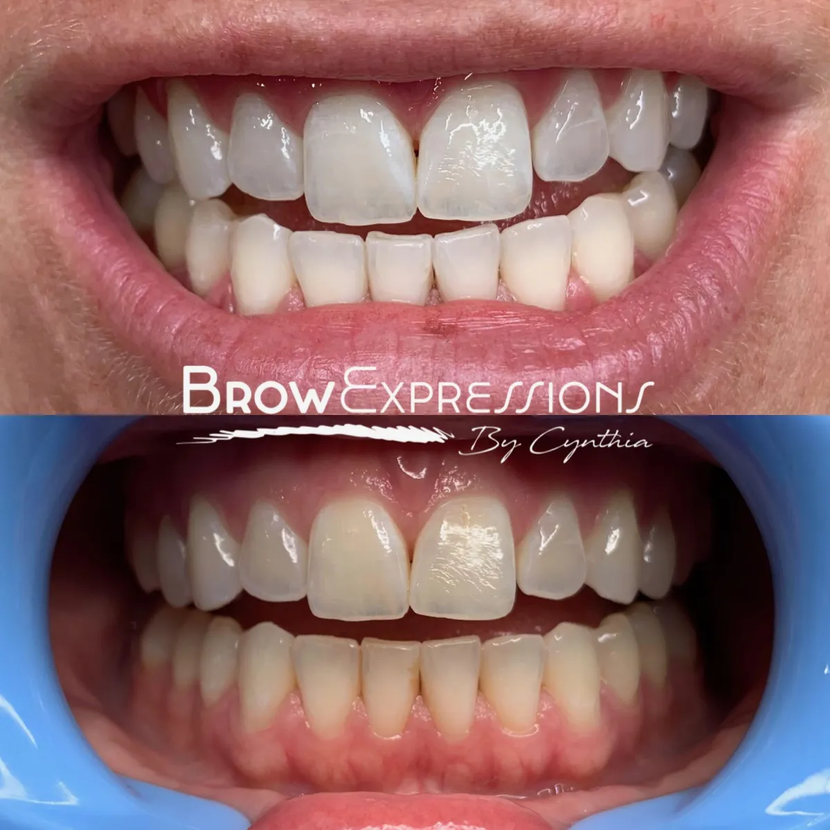 cosmetic teeth whitening
