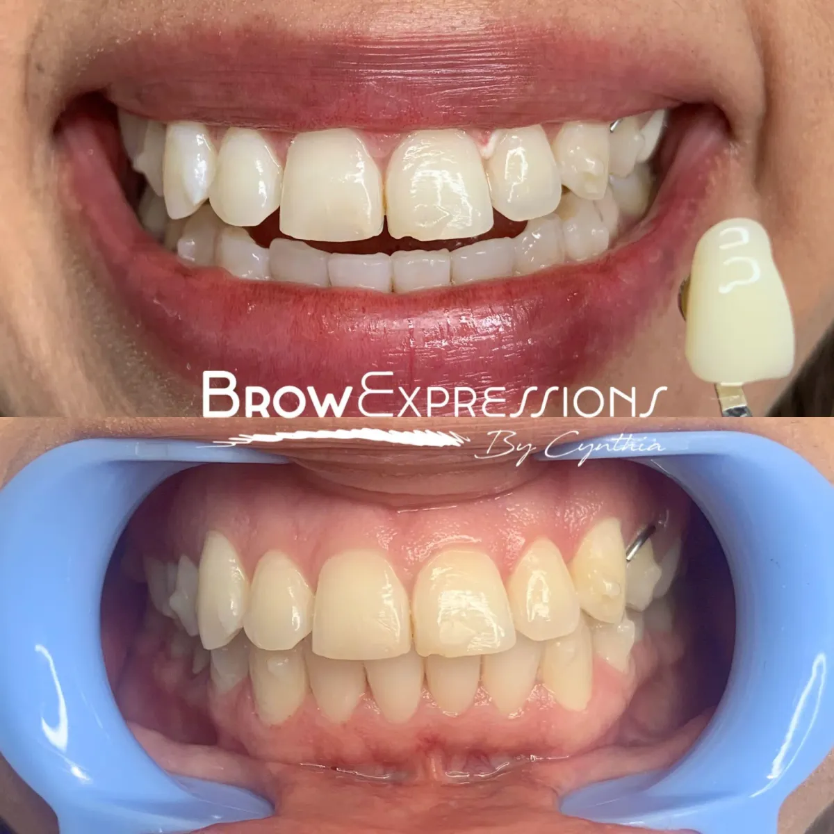 teeth whitening best training