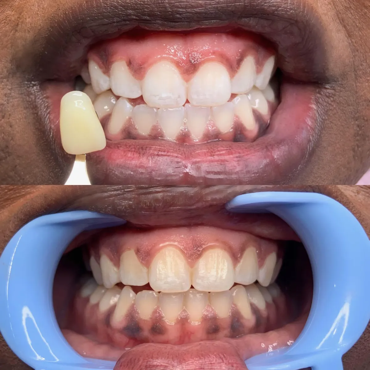 amazing teeth whitening results