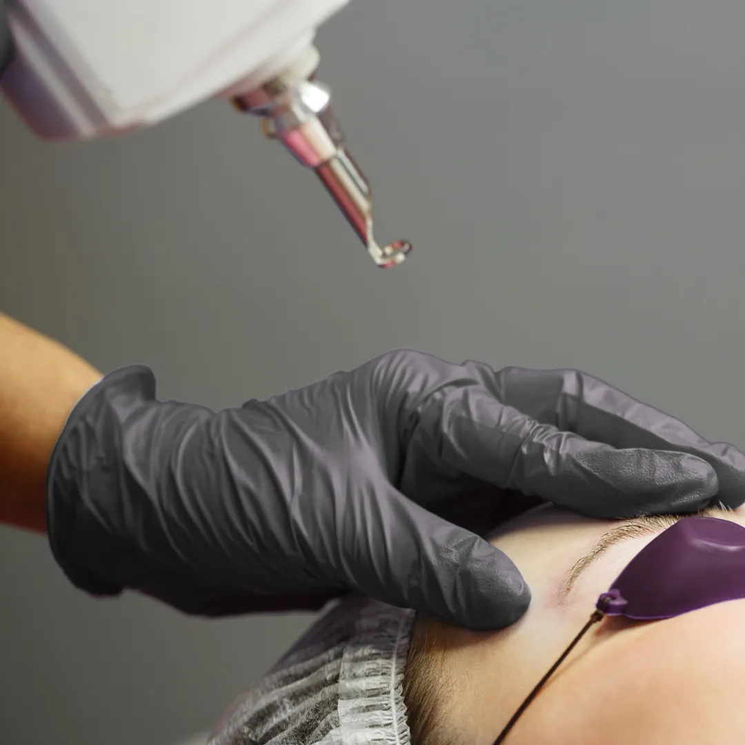 cosmetic tattoo removal