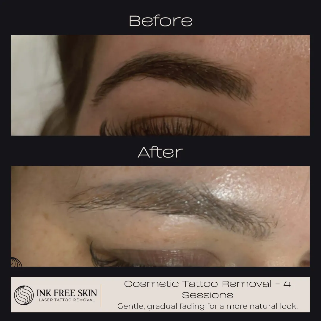 tattoo removal process