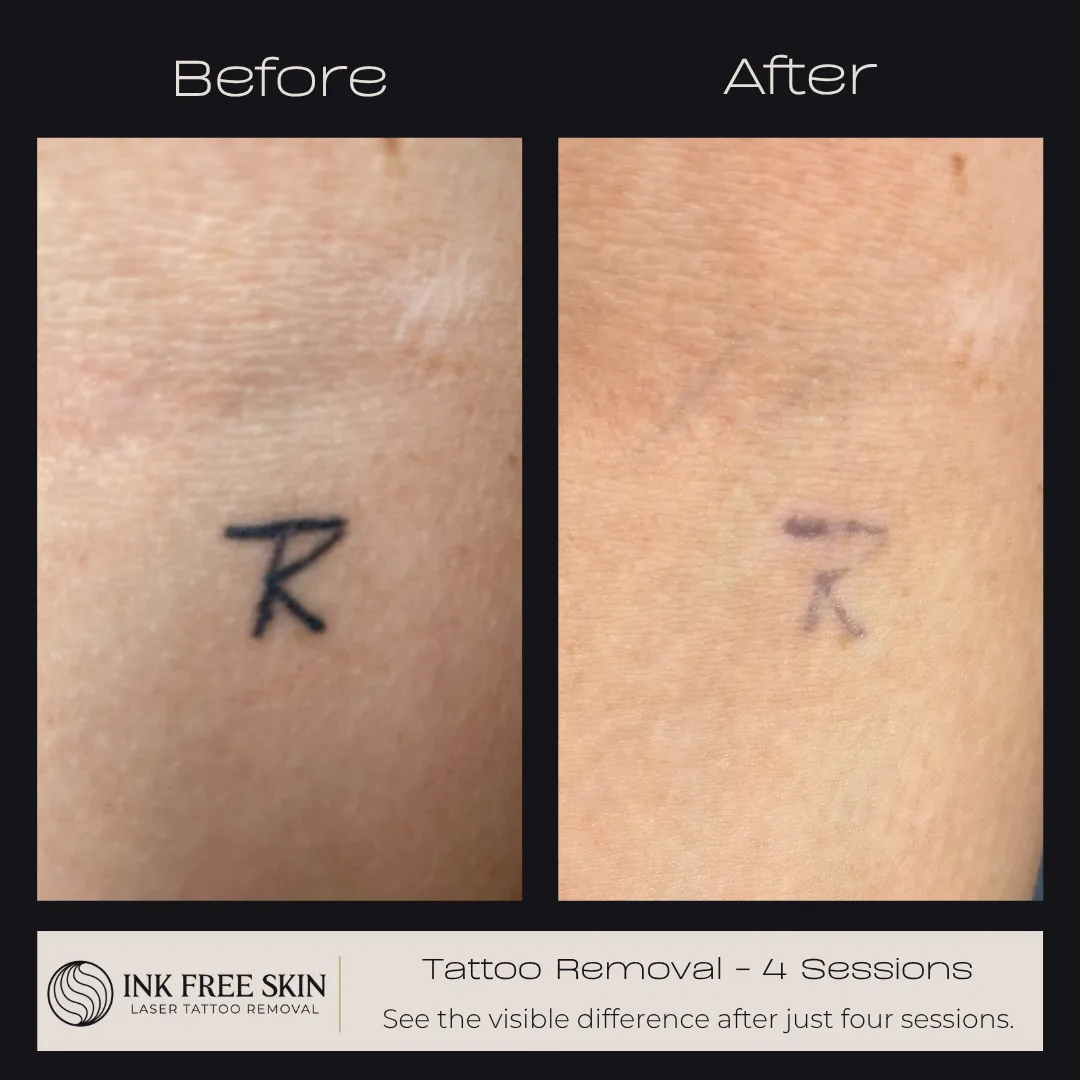 tattoo removal before and after