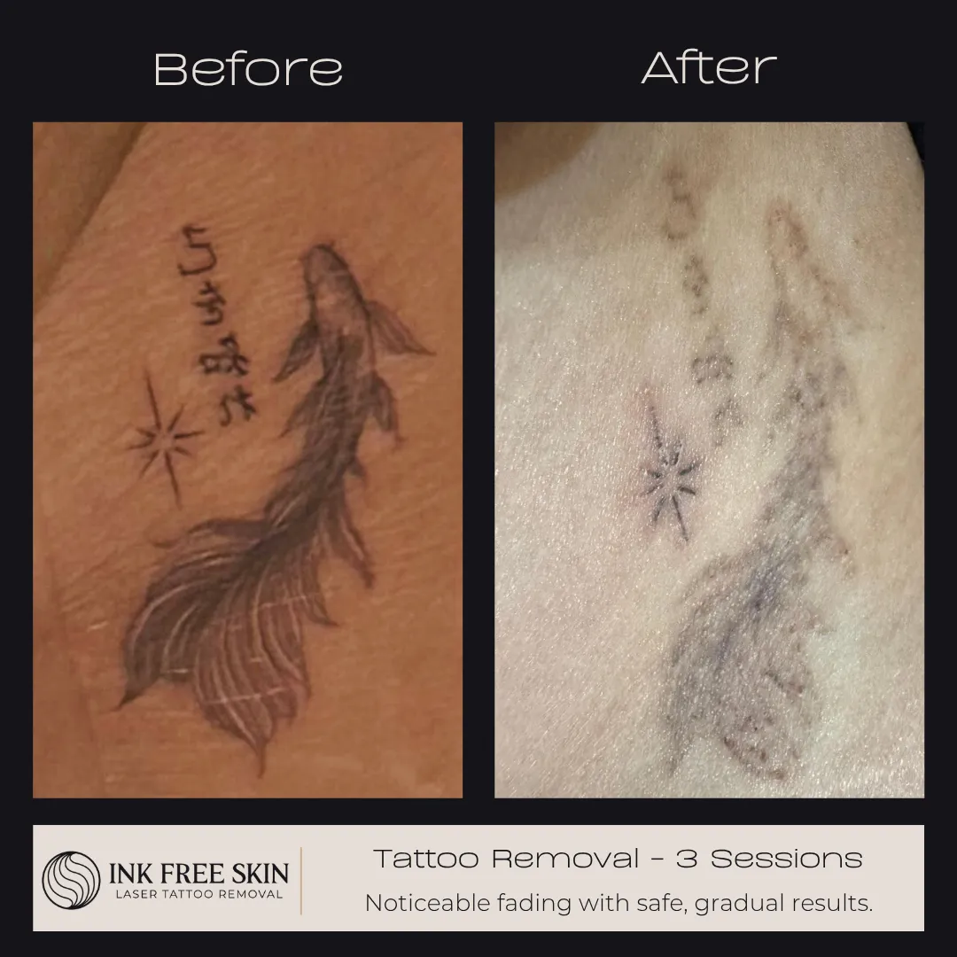 tattoo removal before and after