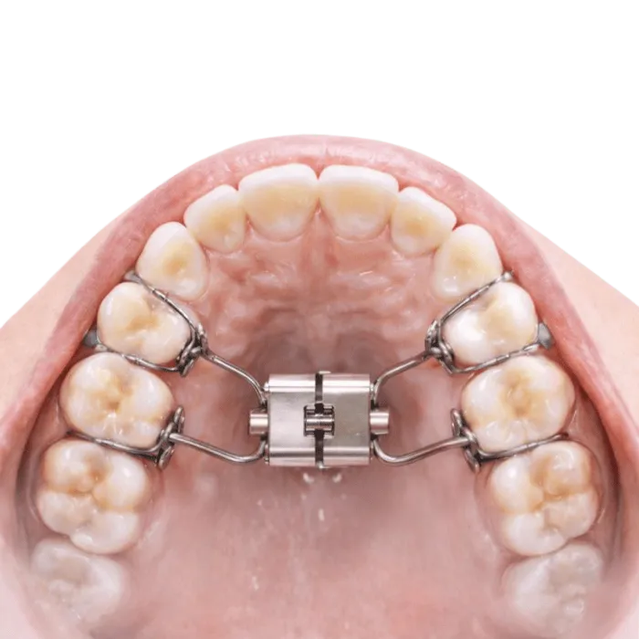 a palatal expander helps with narrow jaw and airway restriction