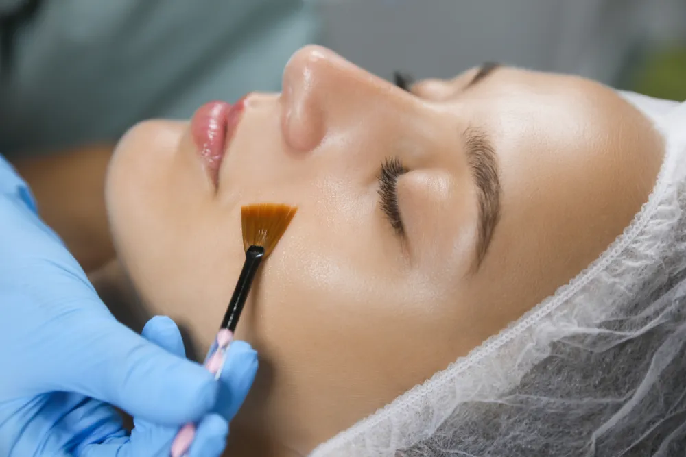 Chemical Peel Florida