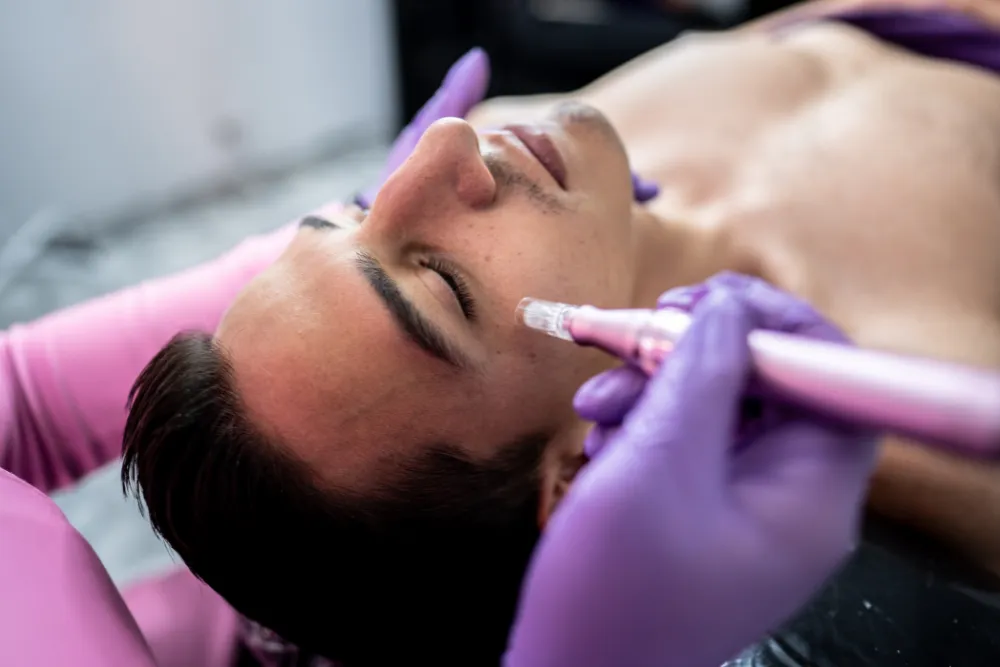 microneedling st pete