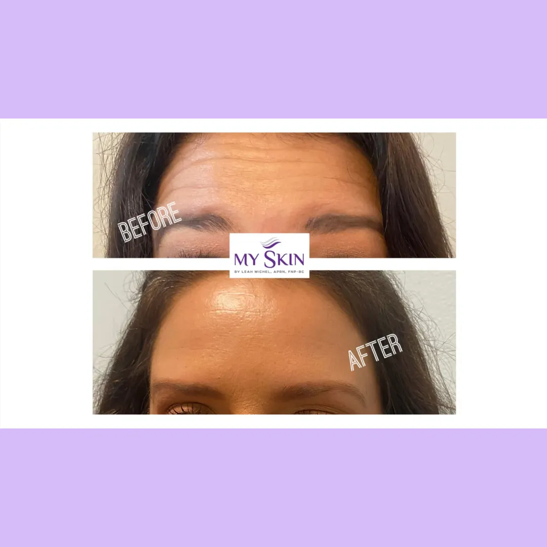 Antiwrinkle treatment at My Skin St Pete
