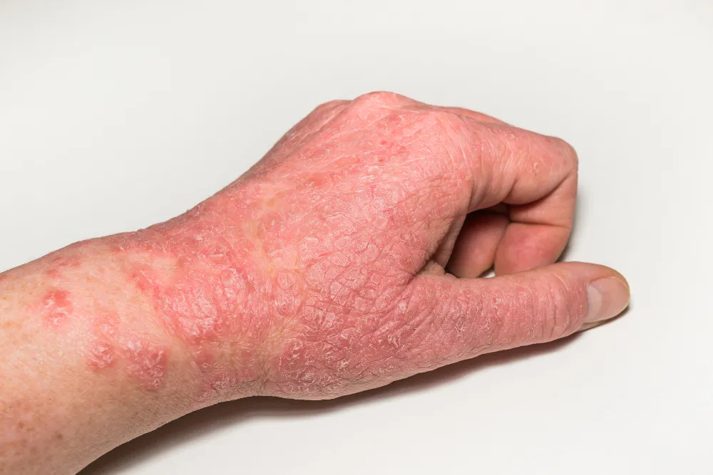 atopic dermatitis eczema st pete bradenton