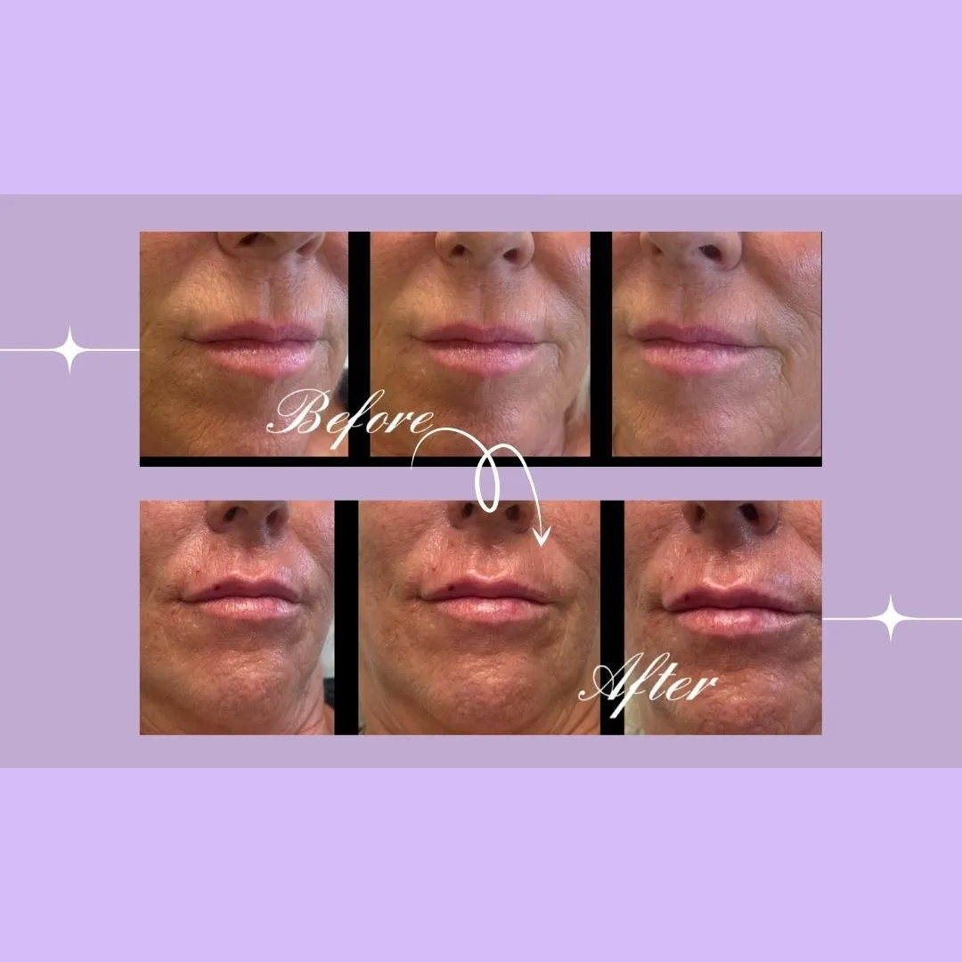 Lip filler before and after treatment at St Pete