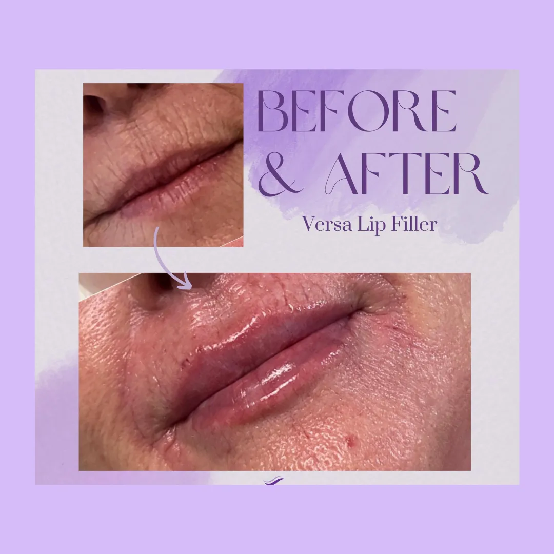 Lip fillers St Pete