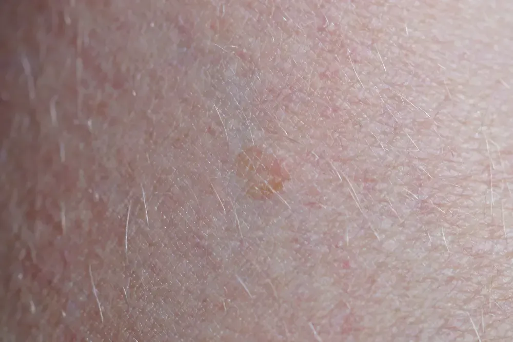 Squamous Cell Carcinoma