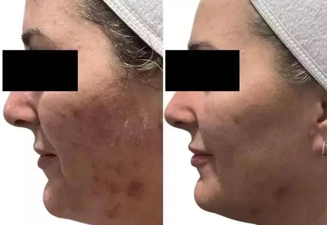 Before and after an AquafirmeXS treatment to treat redness and scarring. Before on the left, after on the right.