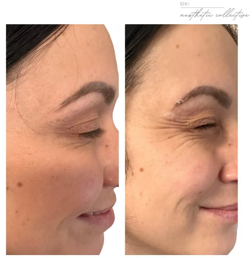 A before and after photo of a woman's side profile. The right image is before, with wrinkles around corners of the eyes. The left image is after Sculptra injectable fillers, showing a reduction in wrinkles and fine lines.