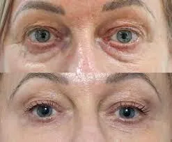 A before and after of treating hooded eyes with TIXEL skin resurfacing. 