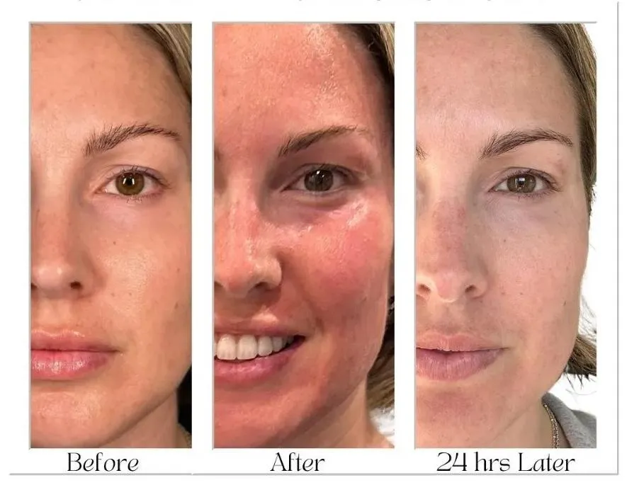 A before and after of a patient who received a PRP microneedling facial from The Aesthetic Collective.