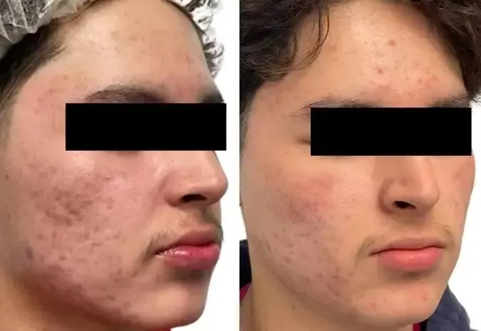 Before and after a hydrafacial treatment on a male's cheeks to address acne scarring and redness.