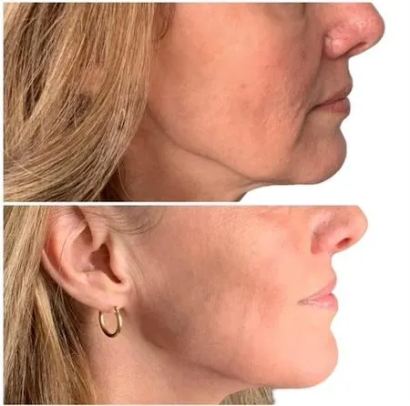 Before and after Cellenis Derma PRP natural fillers with The Aesthetic Collective in Bastrop, TX.