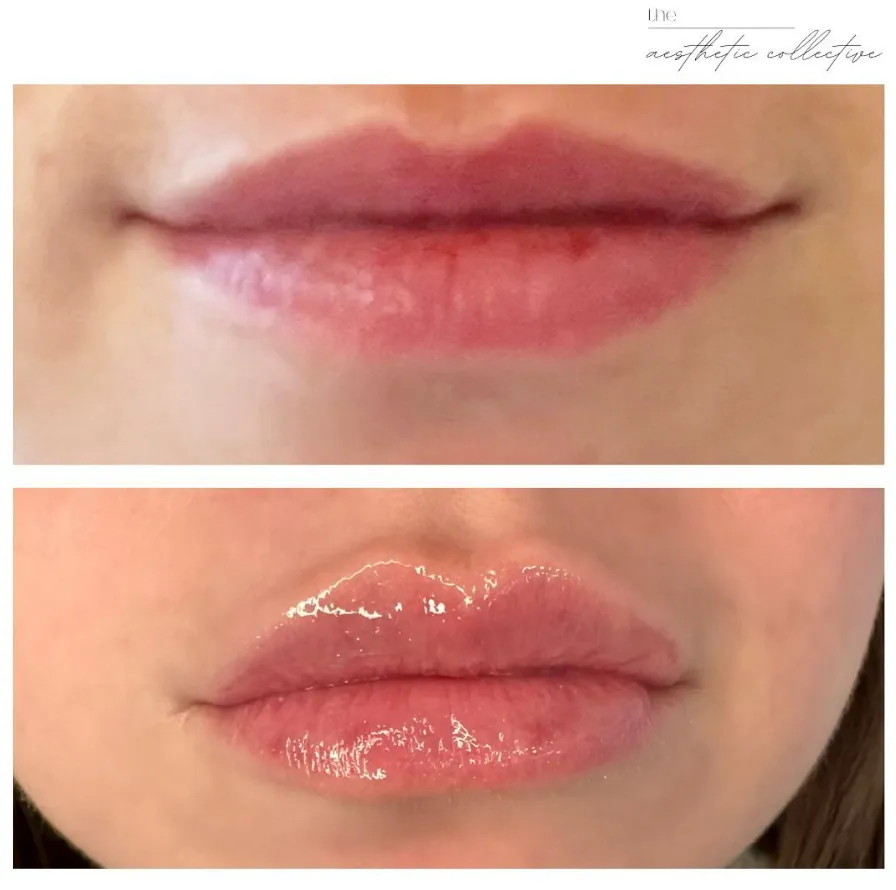 A before and after of a woman after receiving lip fillers from the aesthetic collective in Bastrop, Texas.