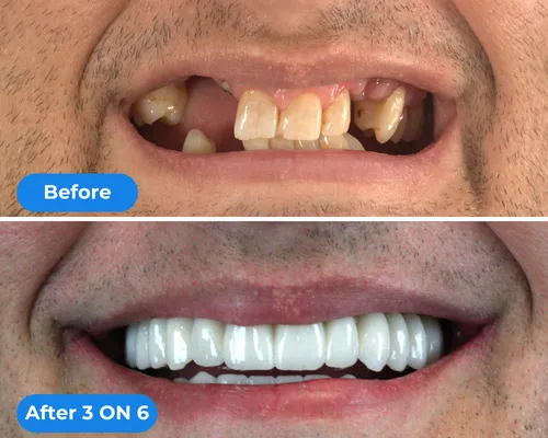 Single Tooth Replacement reviews