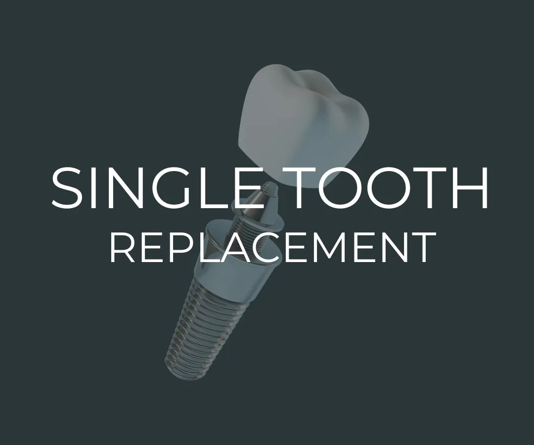 Single Tooth Replacement