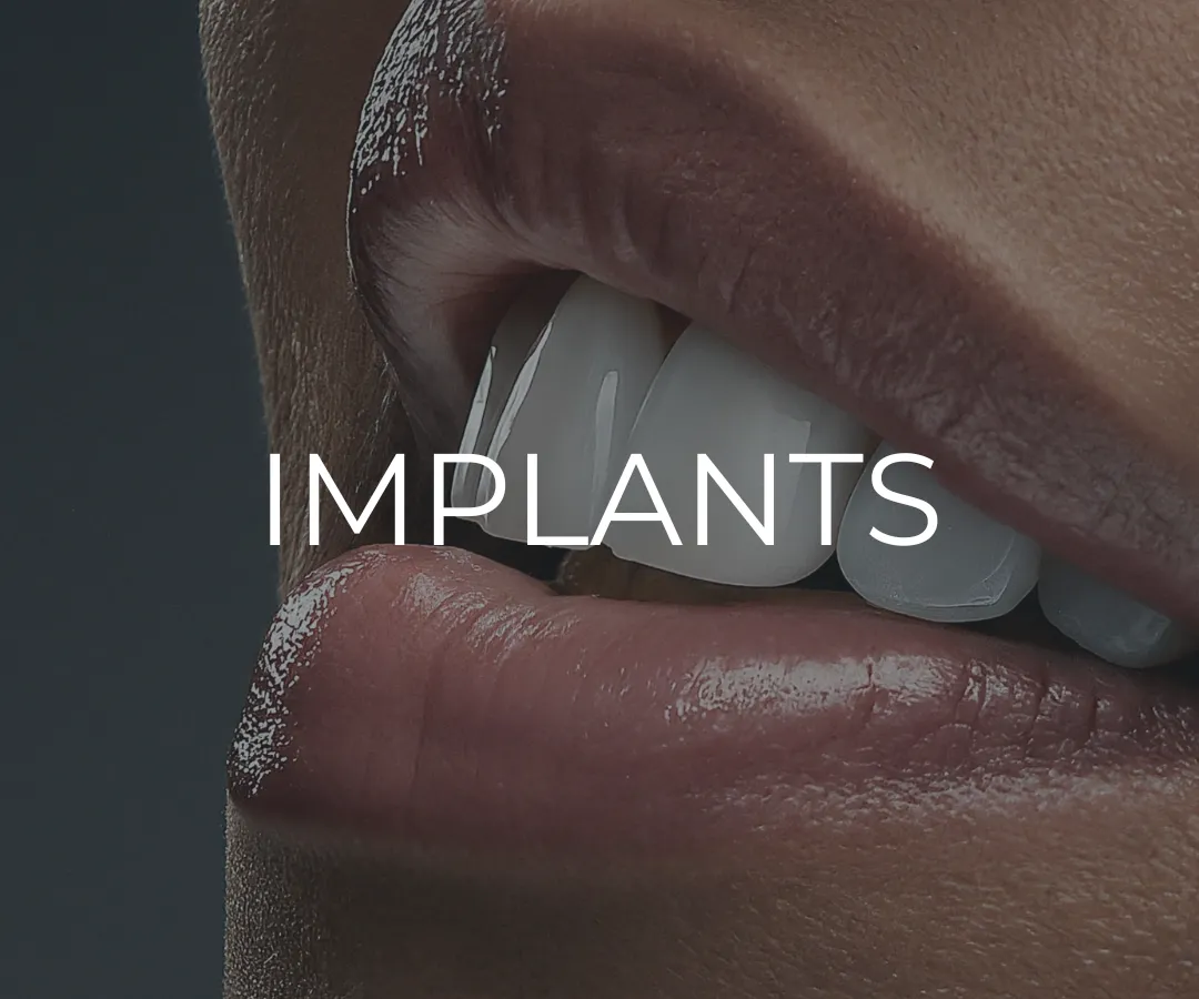 Dental Implants