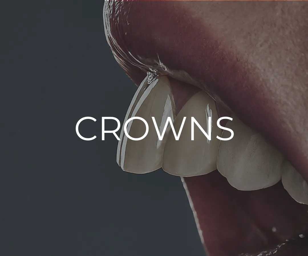 Dental Crowns