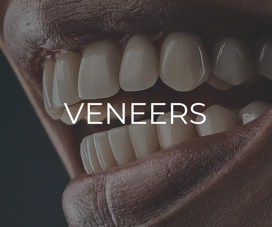 Veneers