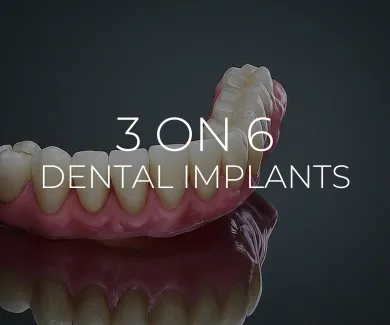 3 ON 6 Dental Implants