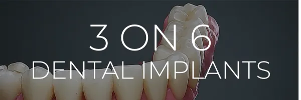 3 ON 6 Dental Implants