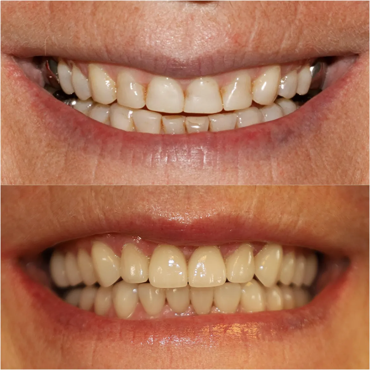 Veneers reviews