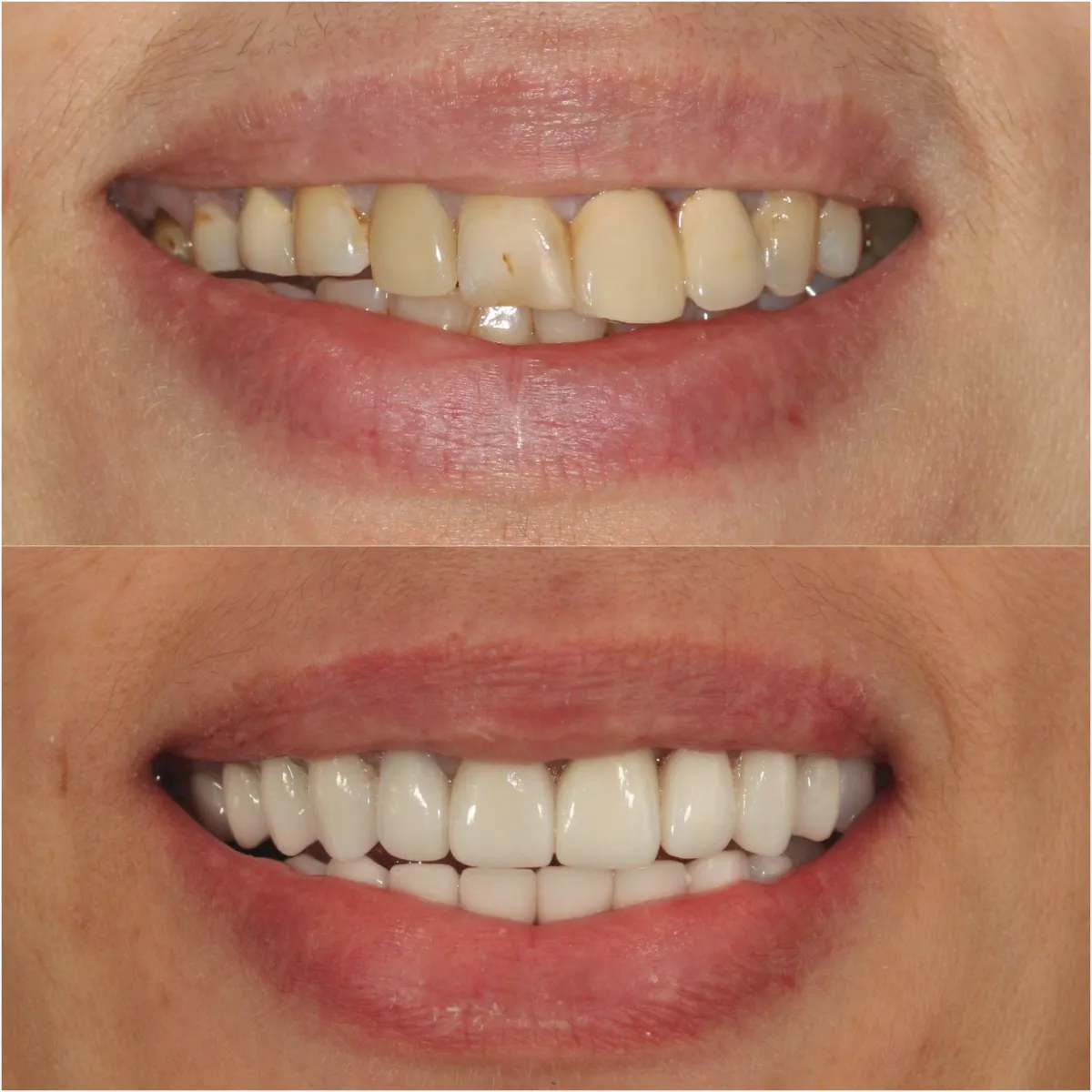 Veneers reviews