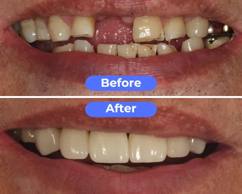 Single Tooth Replacement reviews