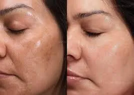 Hyperpigmentation