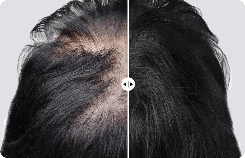 Thinning hair and hair loss