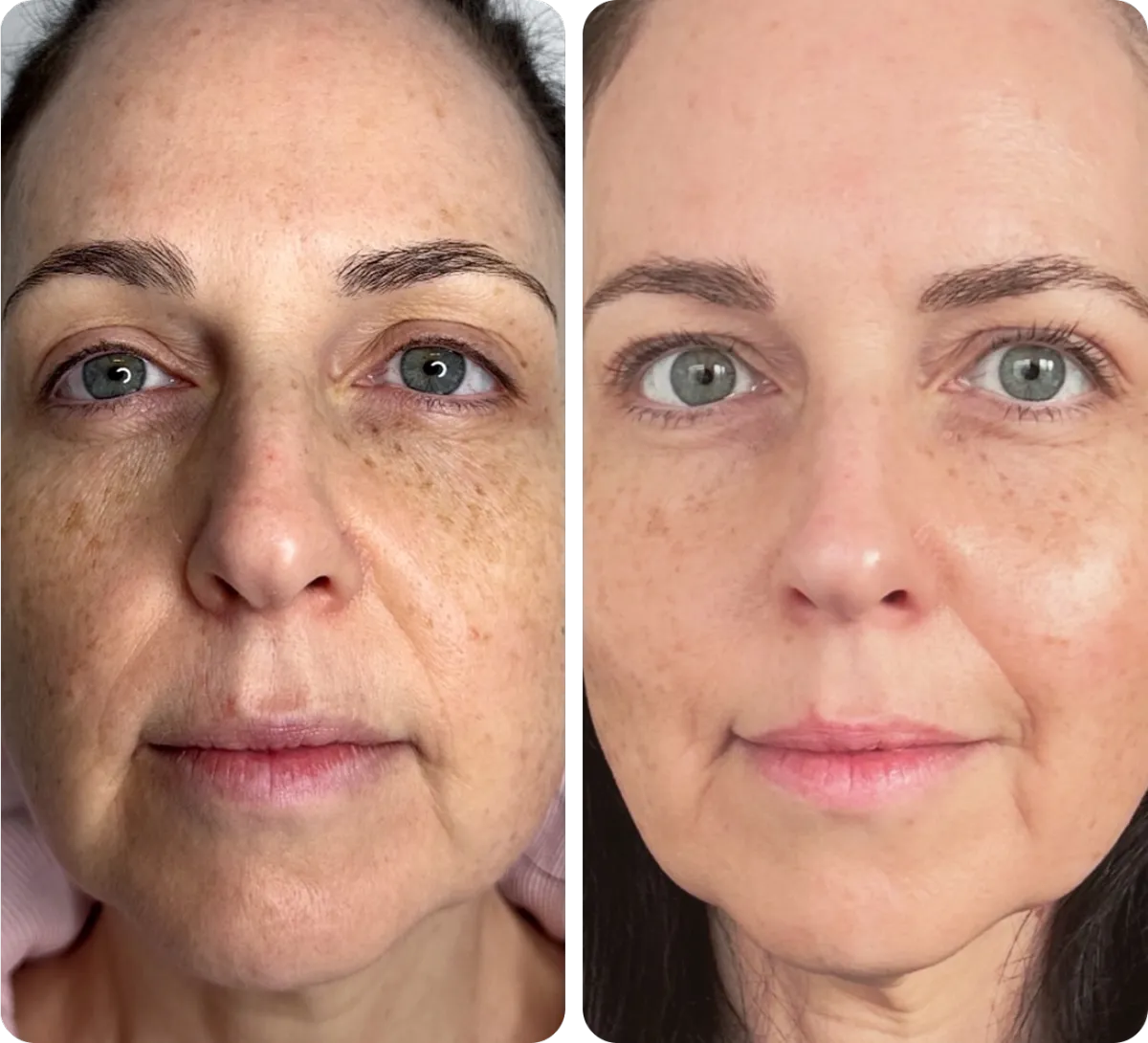 Aesthetic soft-focus facial sculpting technique