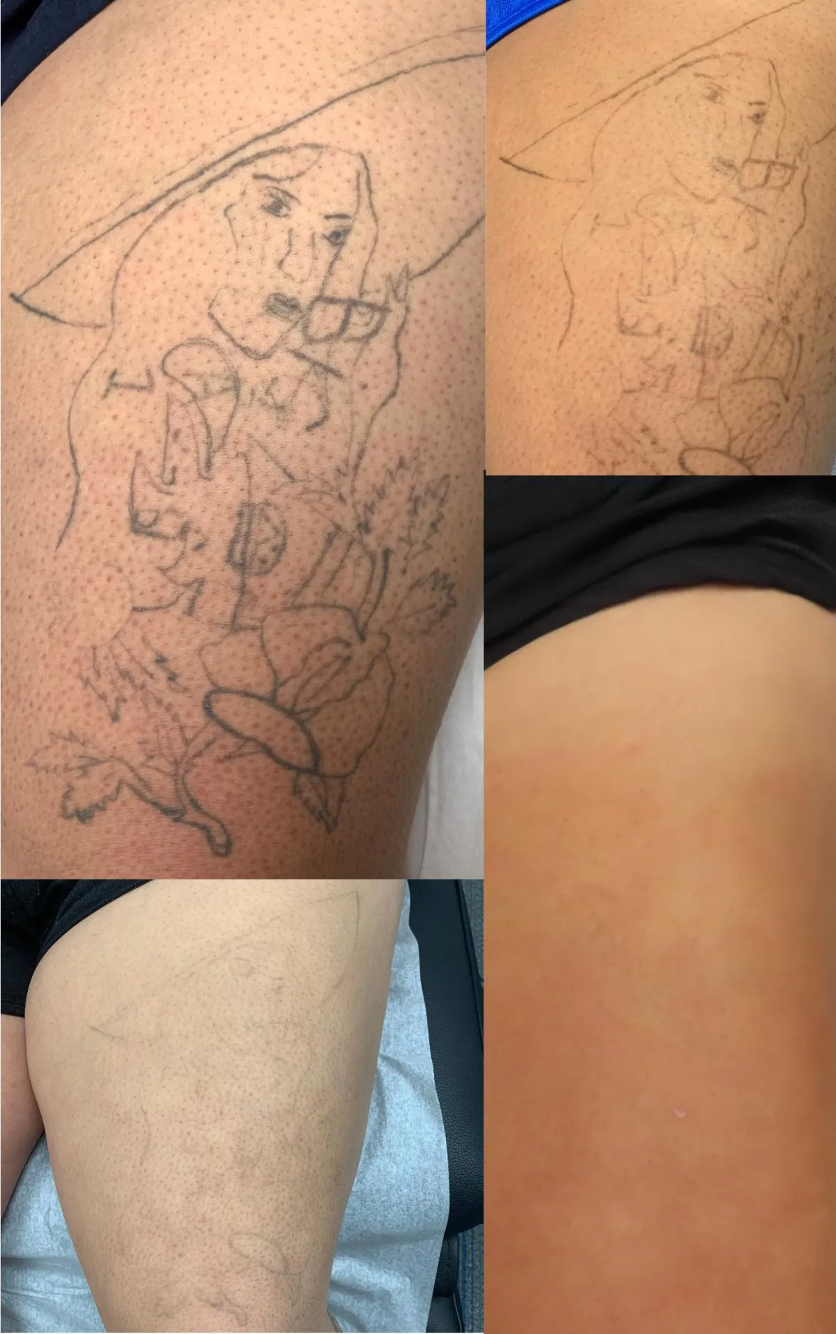 Tattoo Removal | Laser therapy, Tattoo removal, Laser tattoo removal