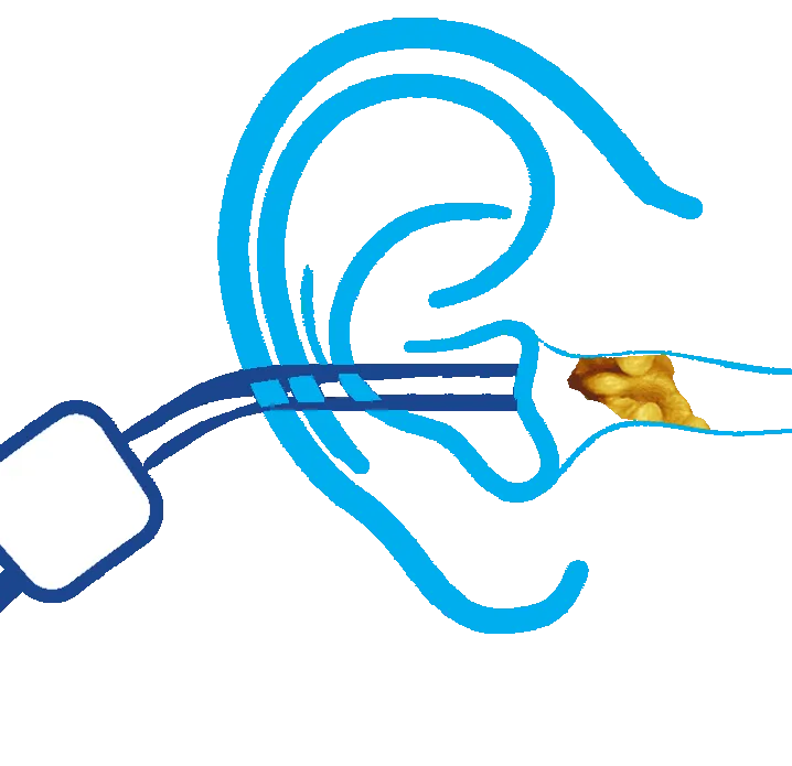 microsuction earwax removal