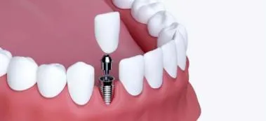 Single Implant and Crown