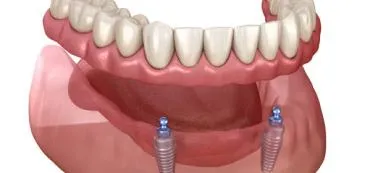 Two Implants with Single Denture
