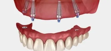 All on 4 Dental Implants