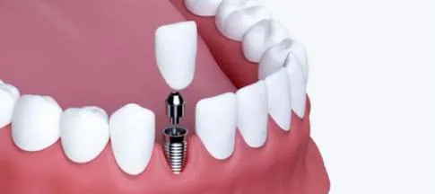 What Are Single Dental Implants?