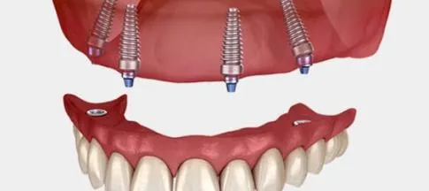 What Are All-on-4 Implants?