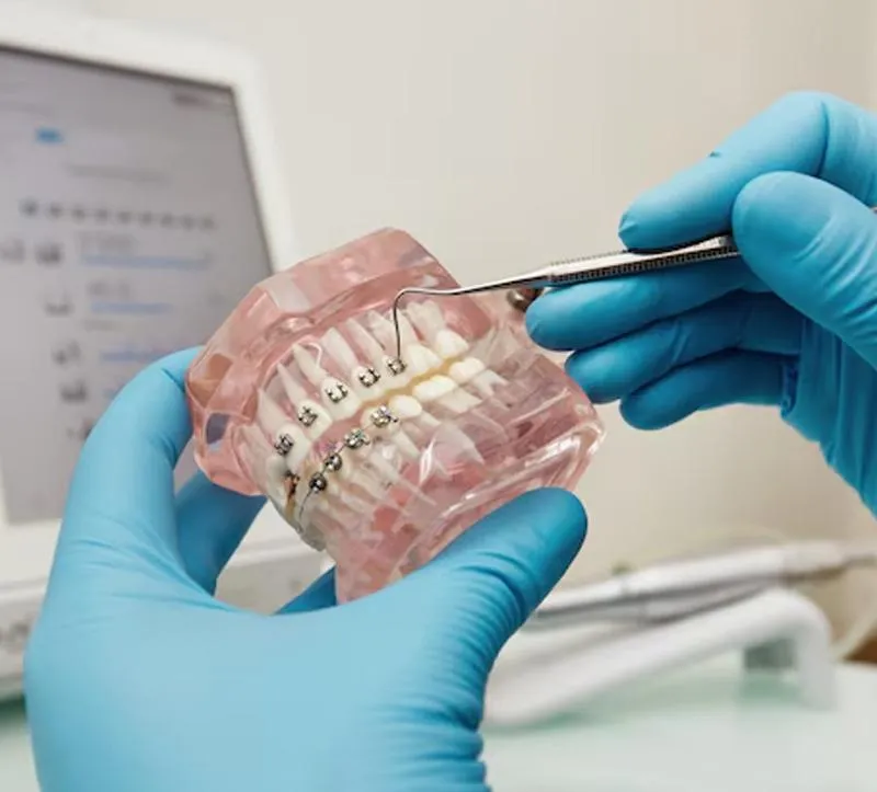 An overview of braces