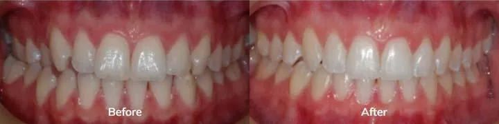 Invisalign 