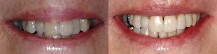 Invisalign 