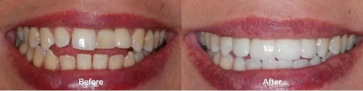 Invisalign 