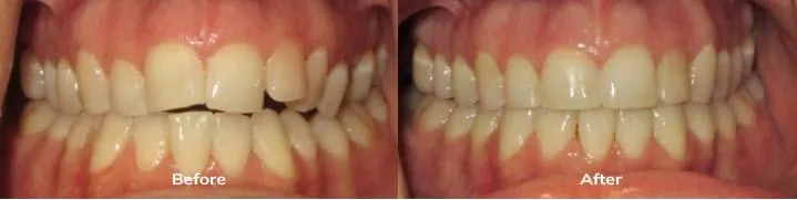 Invisalign 