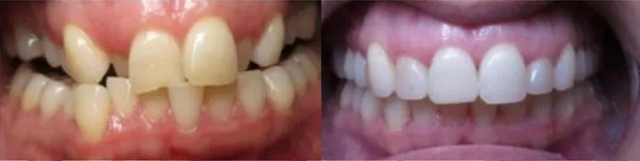 Invisalign 