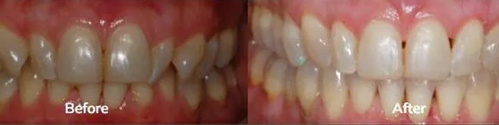 Invisalign 